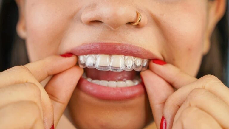 Clear Aligners for Teens
