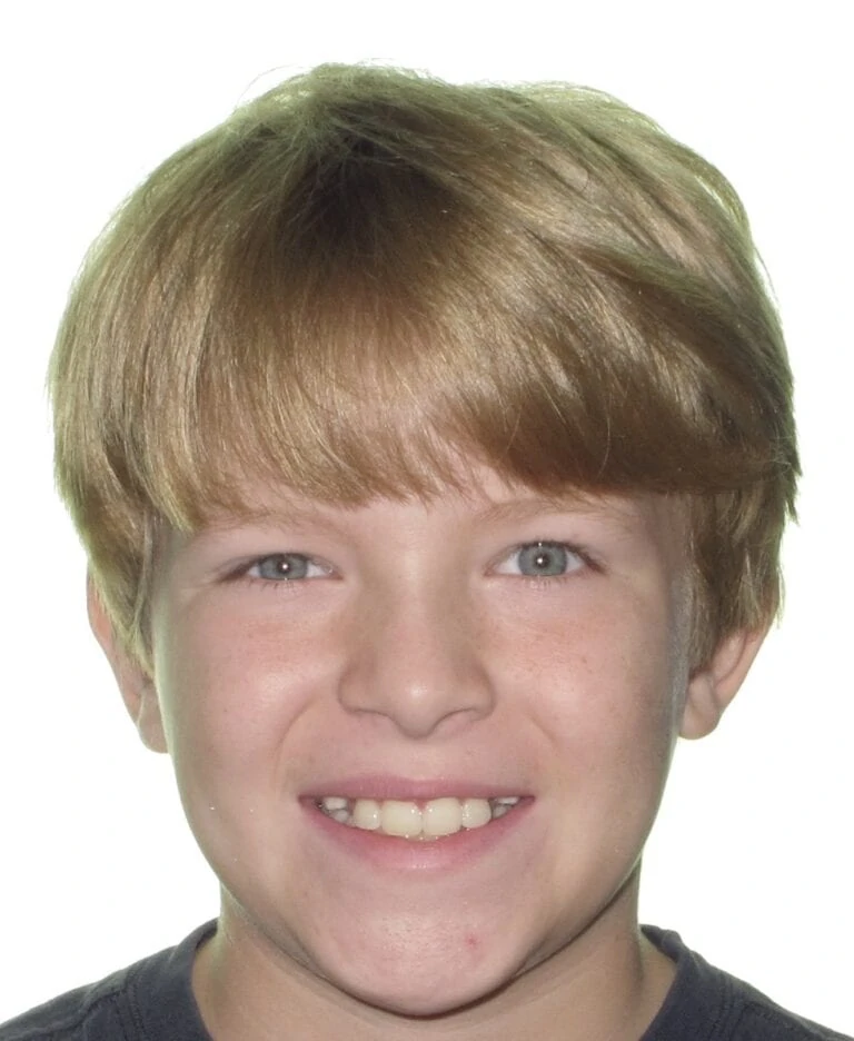 Smiling boy with light brown hair and blue eyes, showcasing a healthy smile, representing successful orthodontic treatment results.